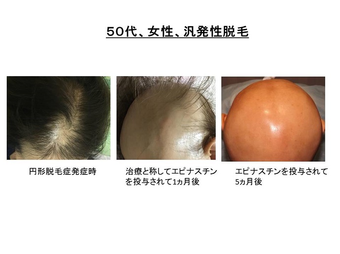 円形脱毛症　病院""